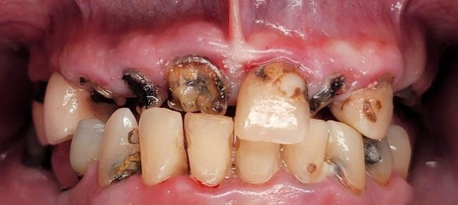 Before Full Mouth Rehabilitation