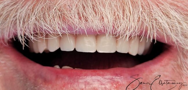 After Full Mouth Rehabilitation