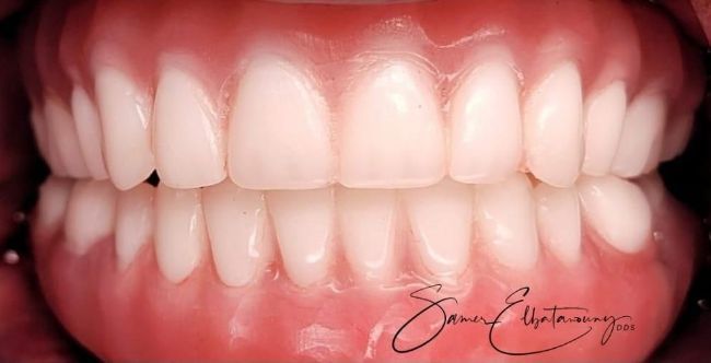 After Full Mouth Rehabilitation