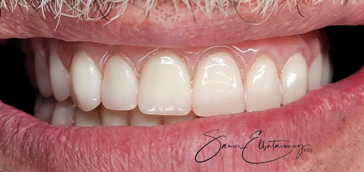 After Gum Contouring