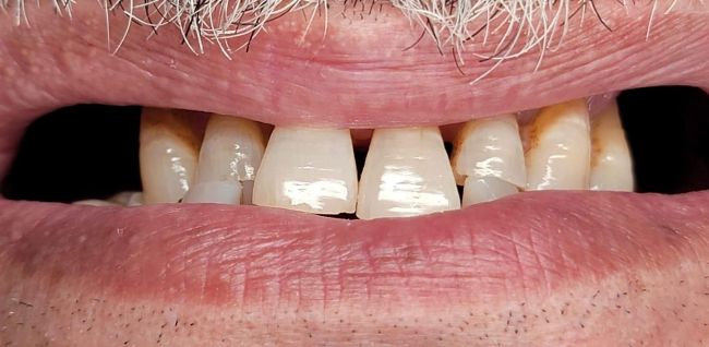 Before Gum Contouring