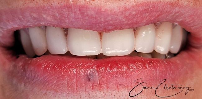 After Composite Bonding 