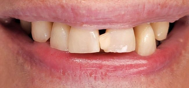 Before Composite Bonding 
