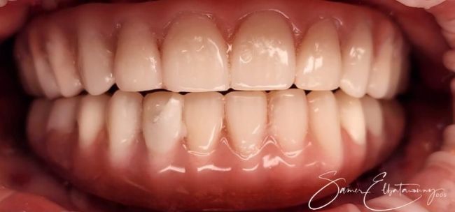 After Full Mouth Rehabilitation