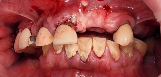 Before Full Mouth Rehabilitation