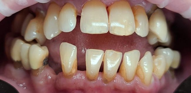 Before Orthodontics