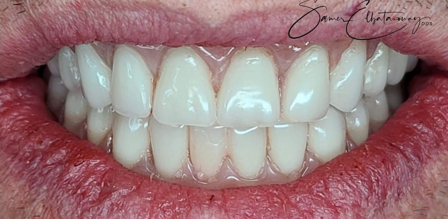 After Orthodontics
