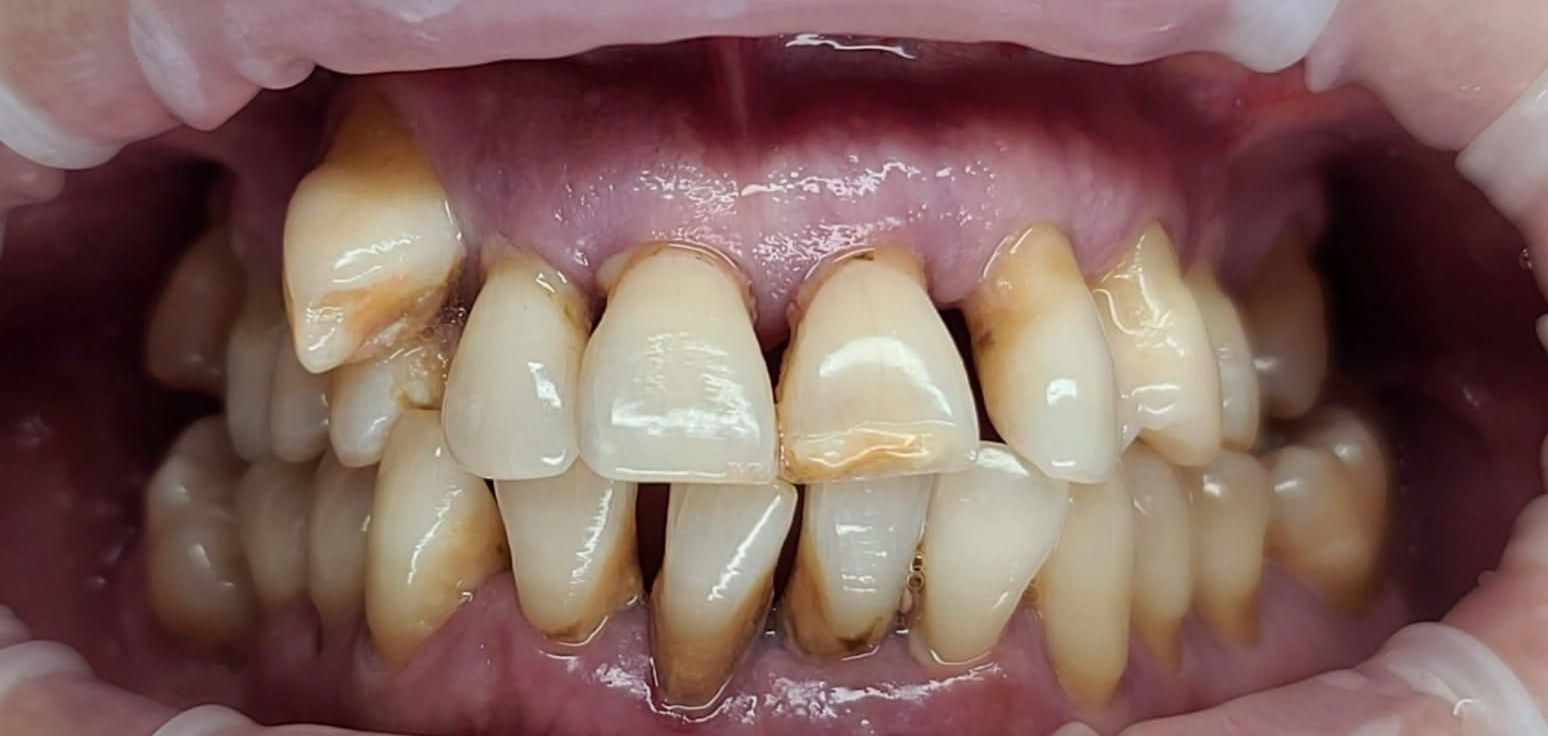 Before Full Mouth Rehabilitation