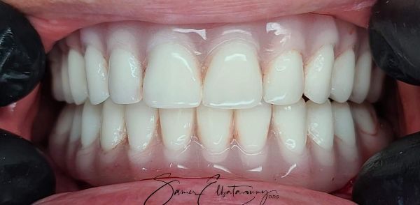 After Full Mouth Rehabilitation