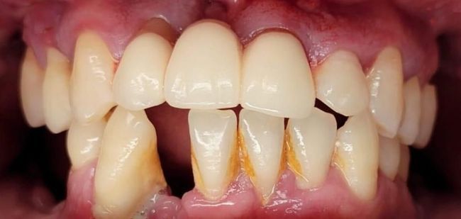 Before Composite Bonding 