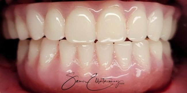 After Composite Bonding 
