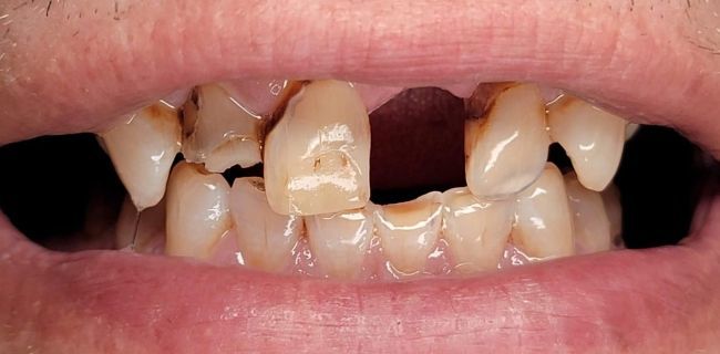 Before Full Mouth Rehabilitation