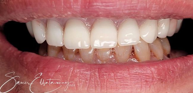 After Full Mouth Rehabilitation