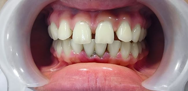 Before Orthodontics
