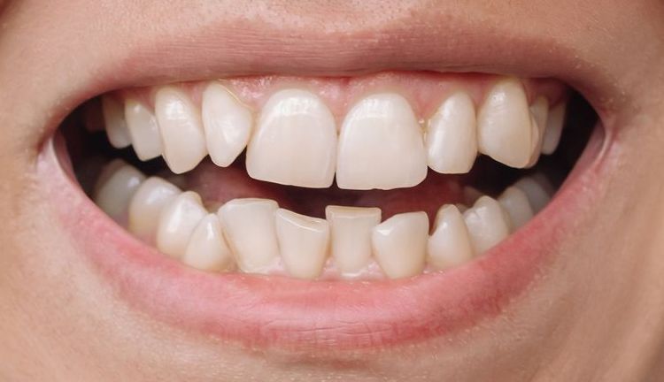 Before Orthodontics