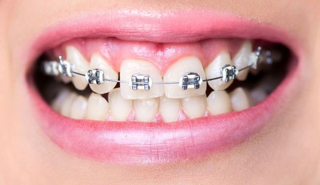 After Orthodontics