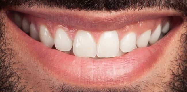 After Teeth Whitening