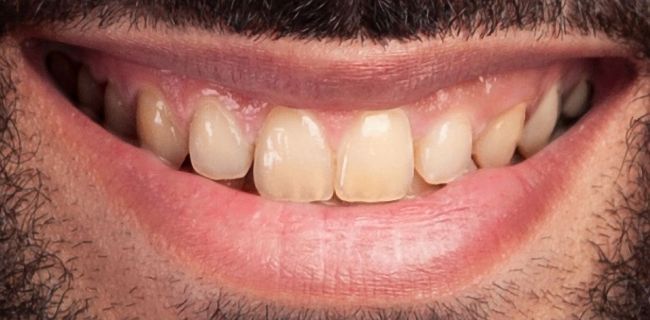 Before Teeth Whitening