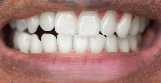 After Teeth Whitening