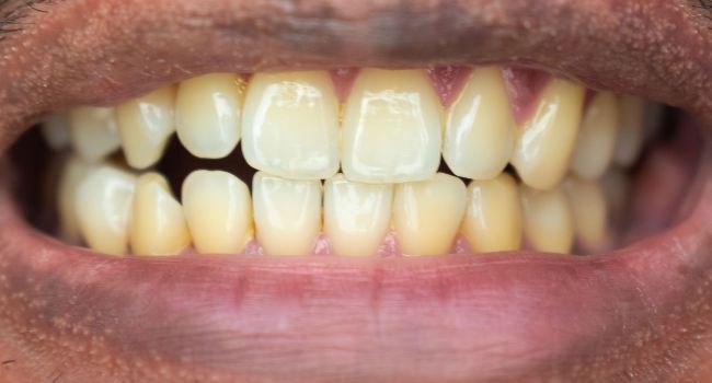 Before Teeth Whitening