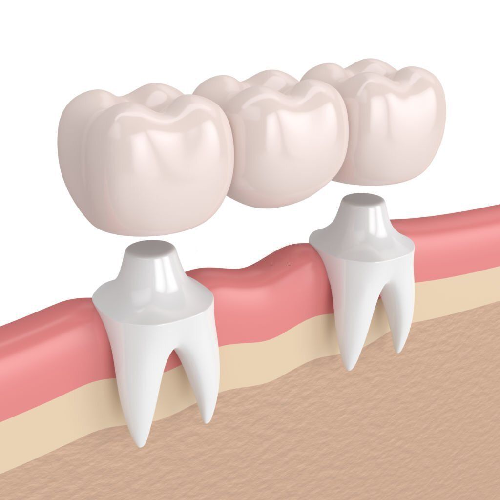 Dental Bridges Last