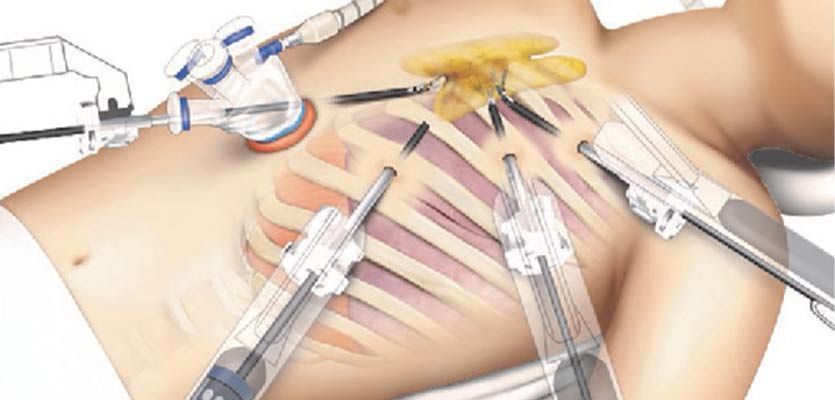 Medical illustration of instruments inserted into a chest cavity, depicting a minimally invasive surgery procedure.