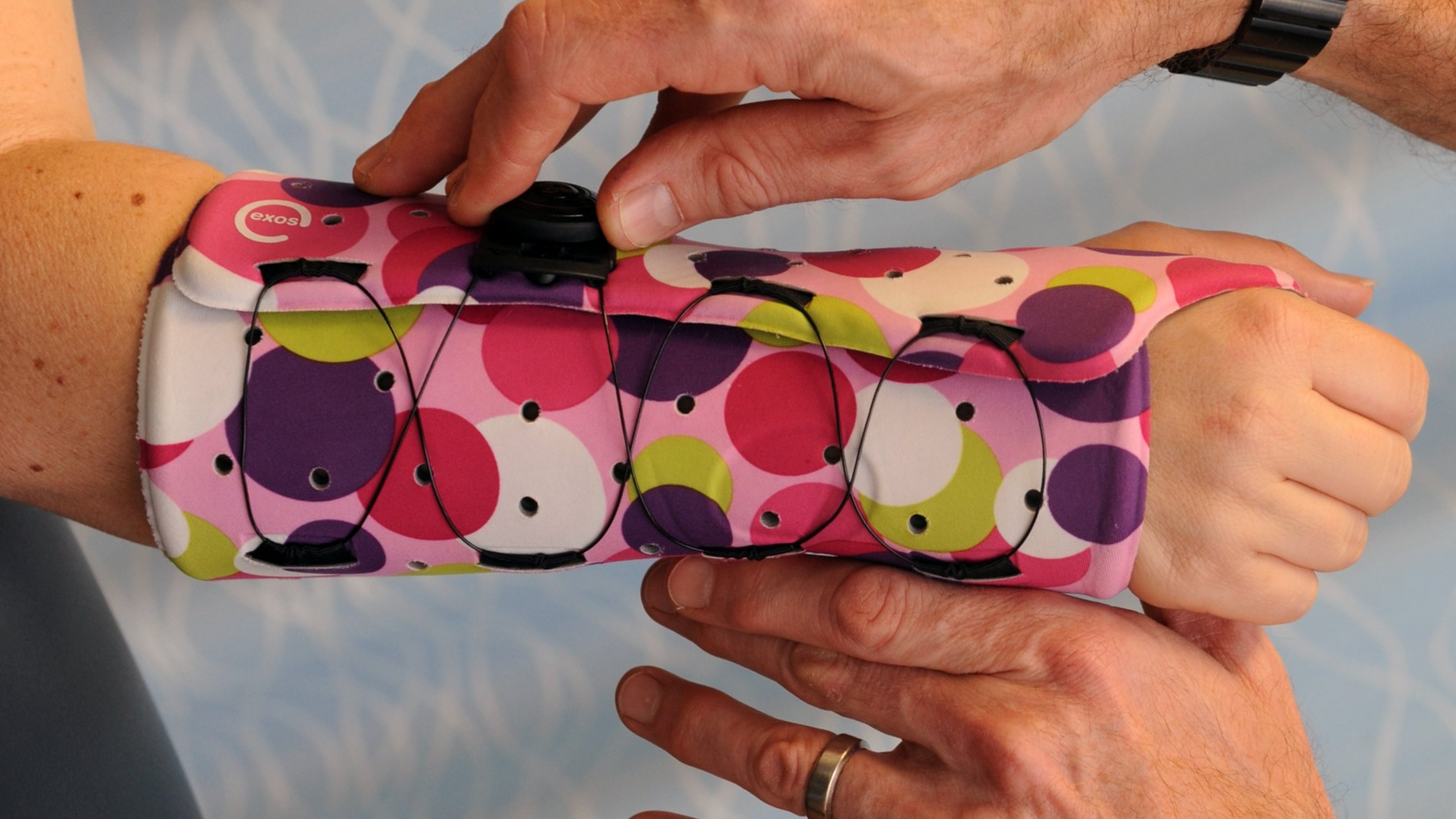 Exos splint for wrist fracture