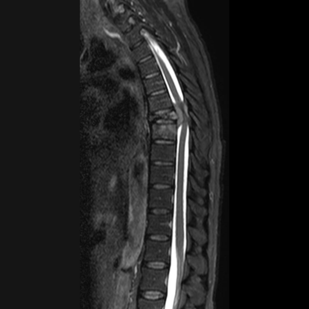 Complicações do Mieloma