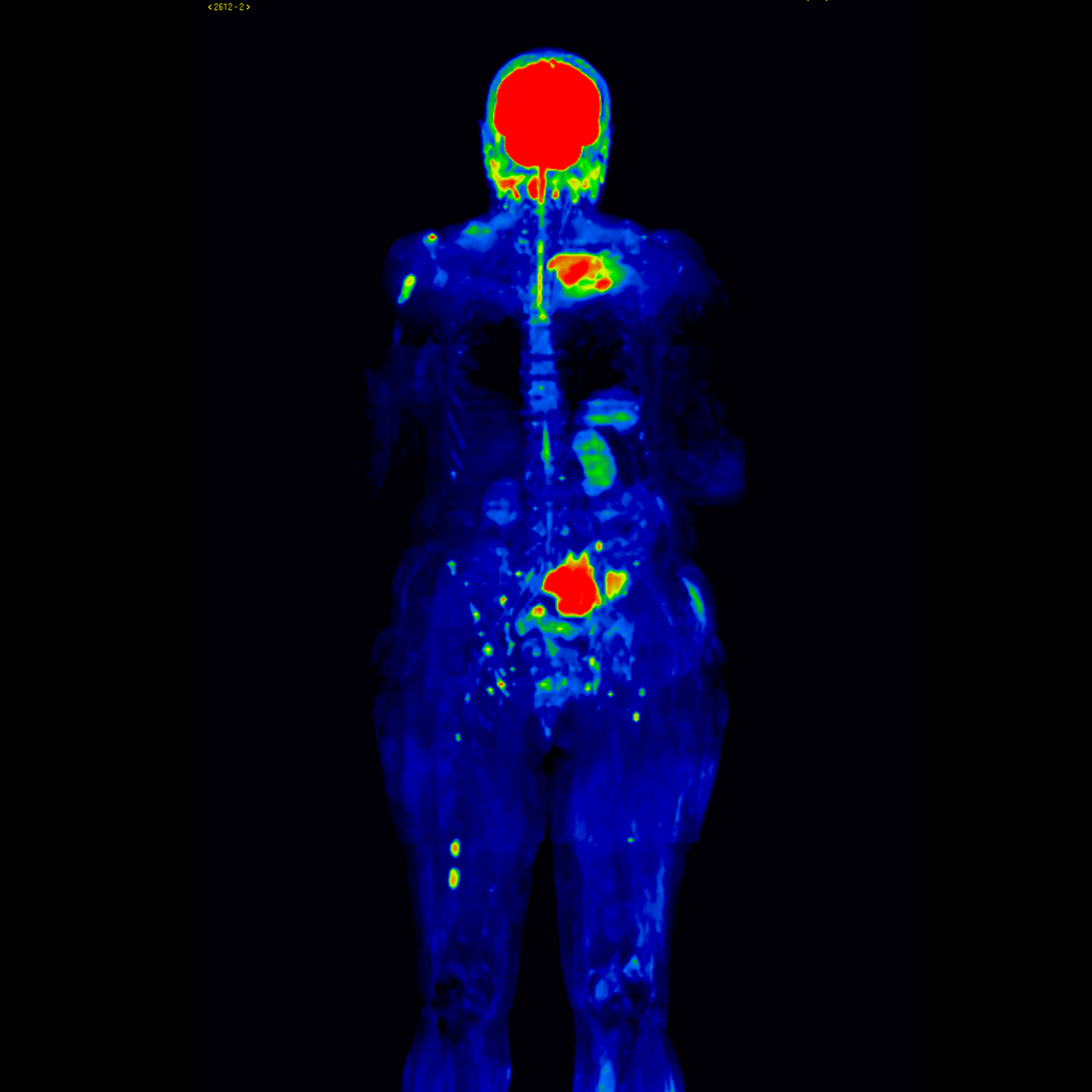 Imagem no Diagnóstico do Mieloma