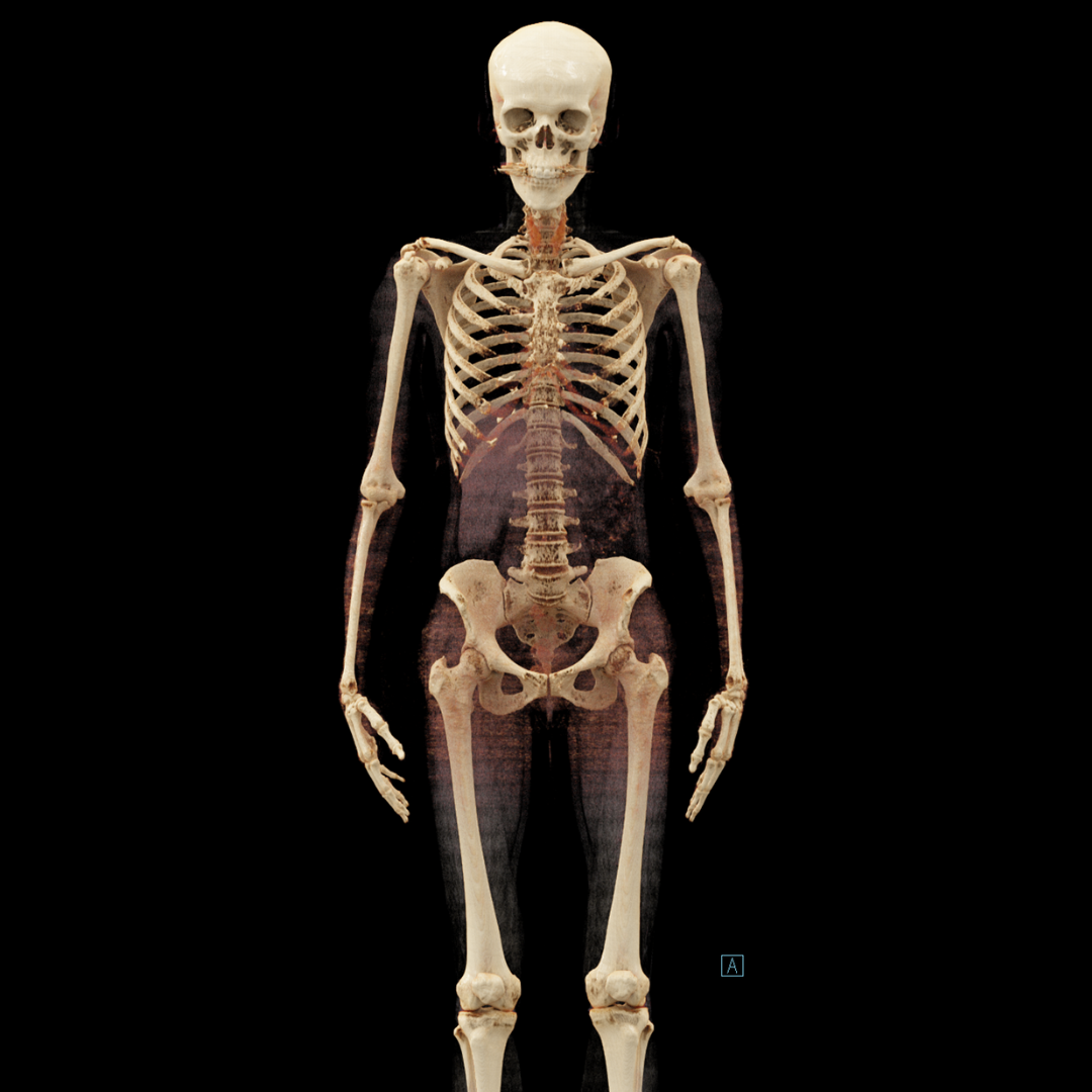 Estadiamento do Mieloma por Imagem