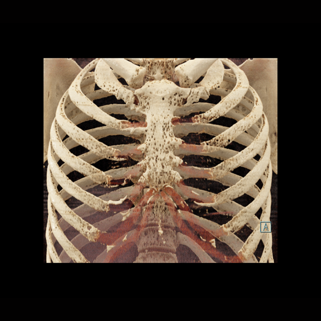 Lesões Ósseas no Mieloma