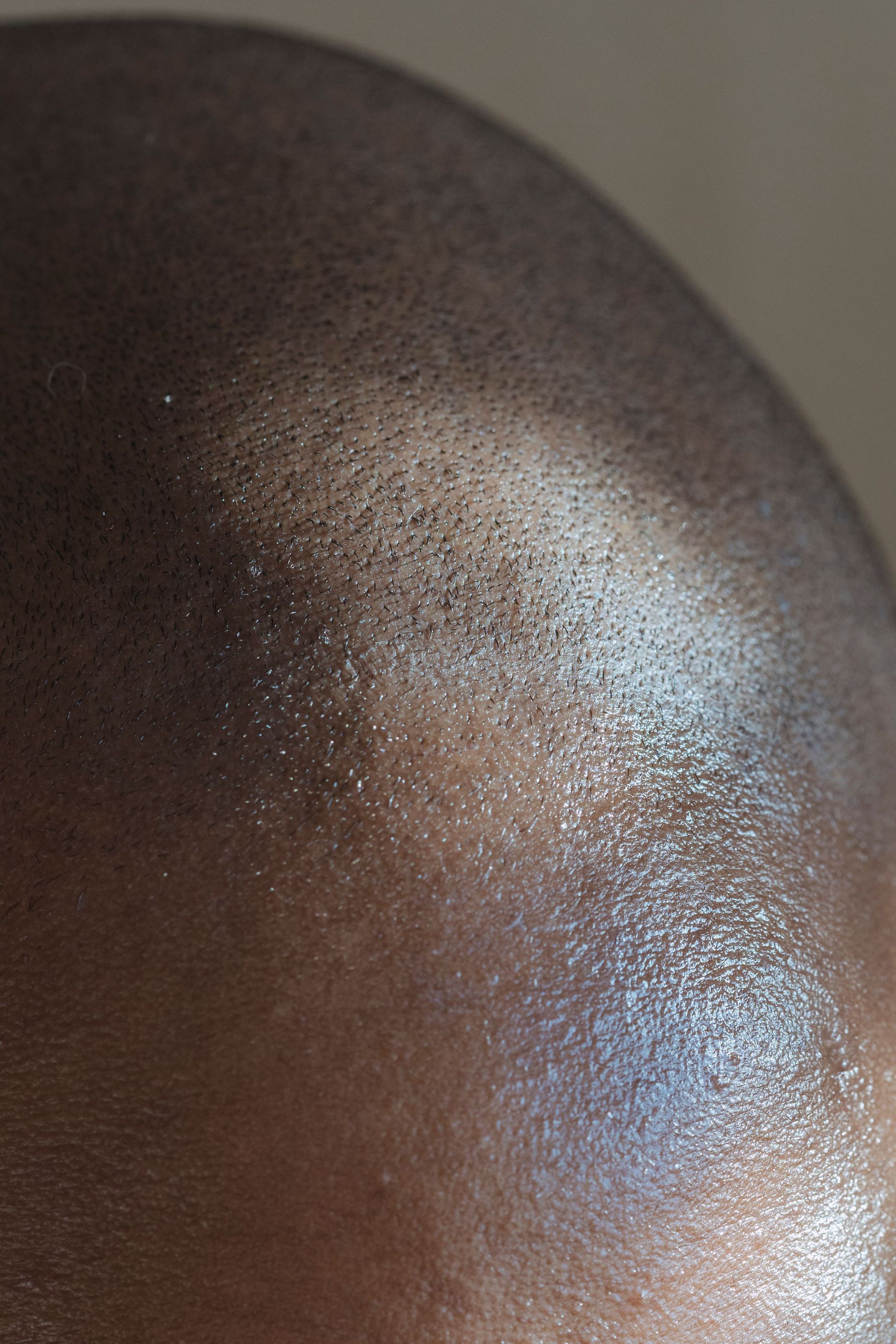 Närbild på hårbotten med scalp micropigmentation som ger tätare intryck, SMP-behandling i Eskilstuna