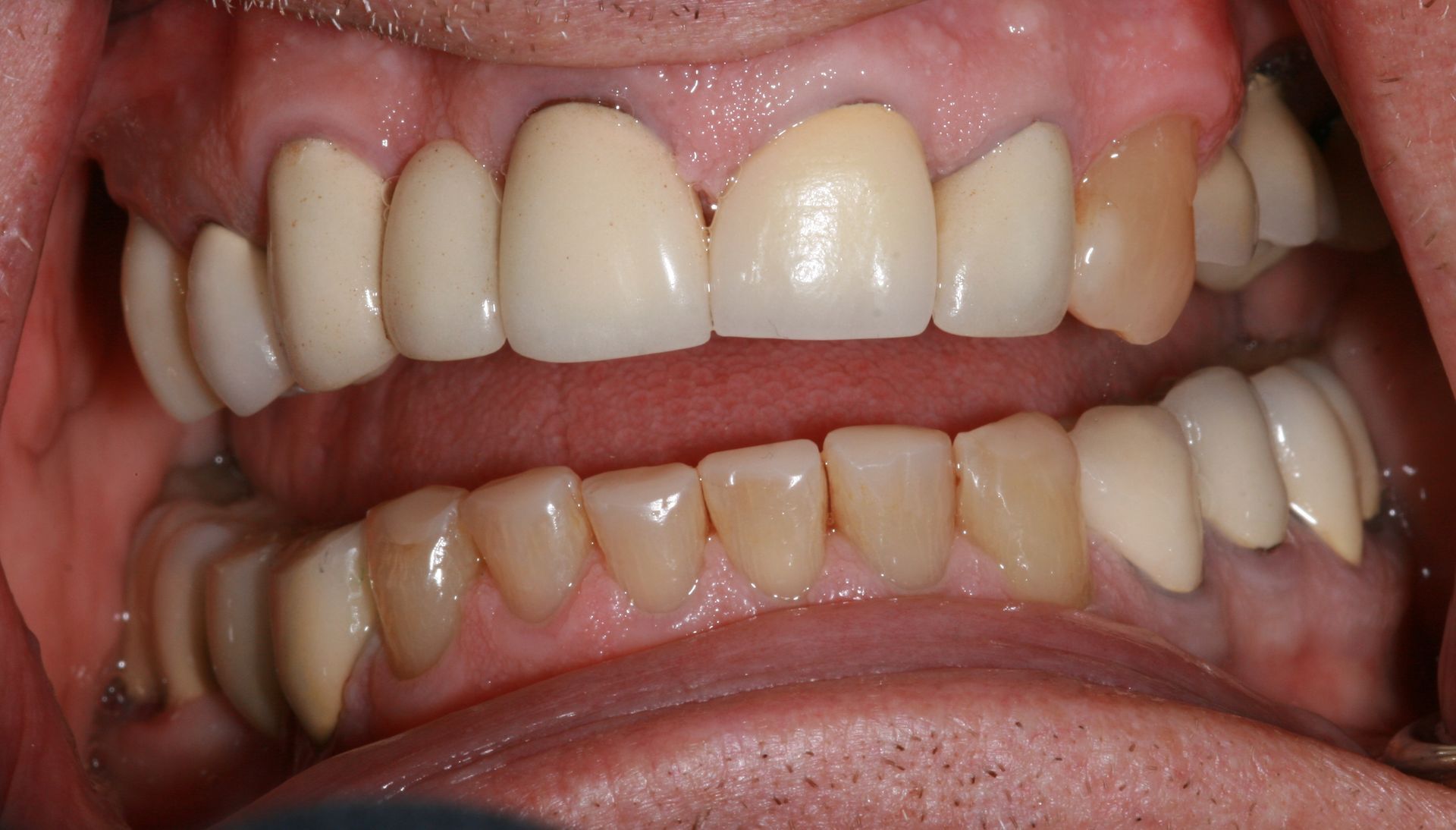A close up of a man 's teeth with a crown on one of them.