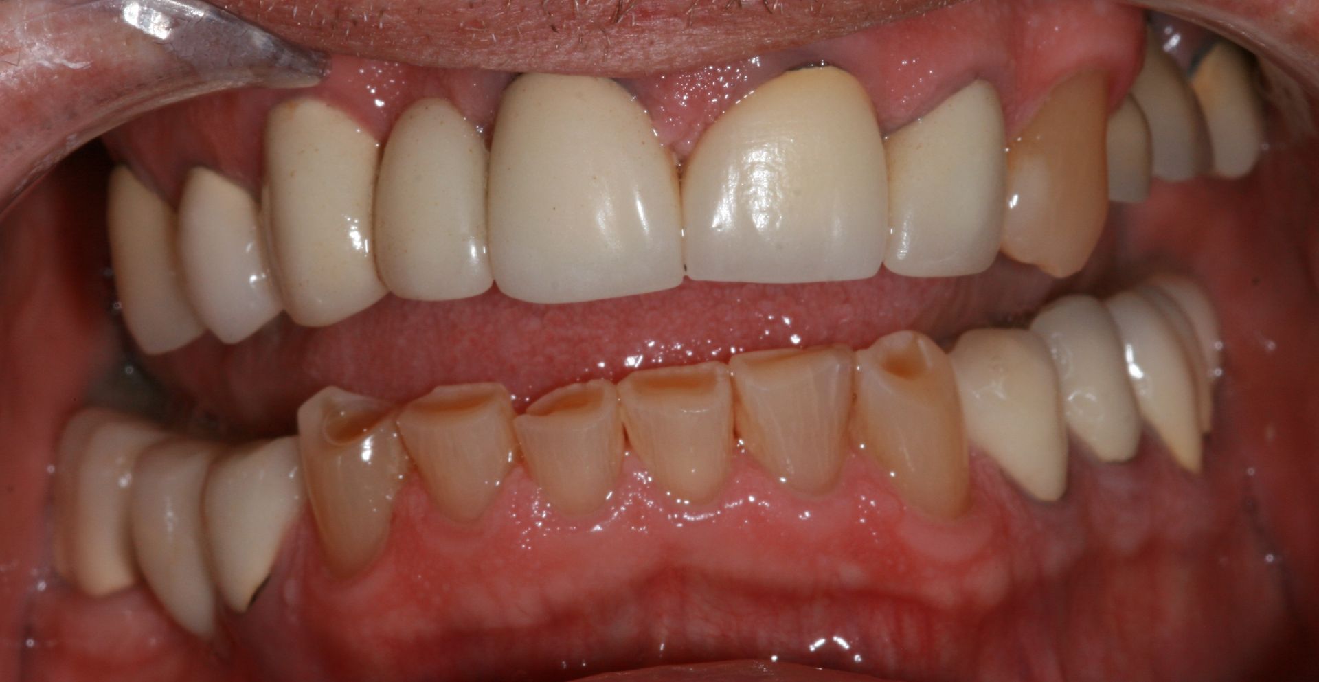 A close up of a person 's teeth with a crown.