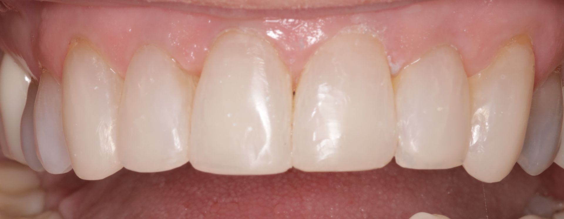 A close up of a person 's teeth with white teeth.