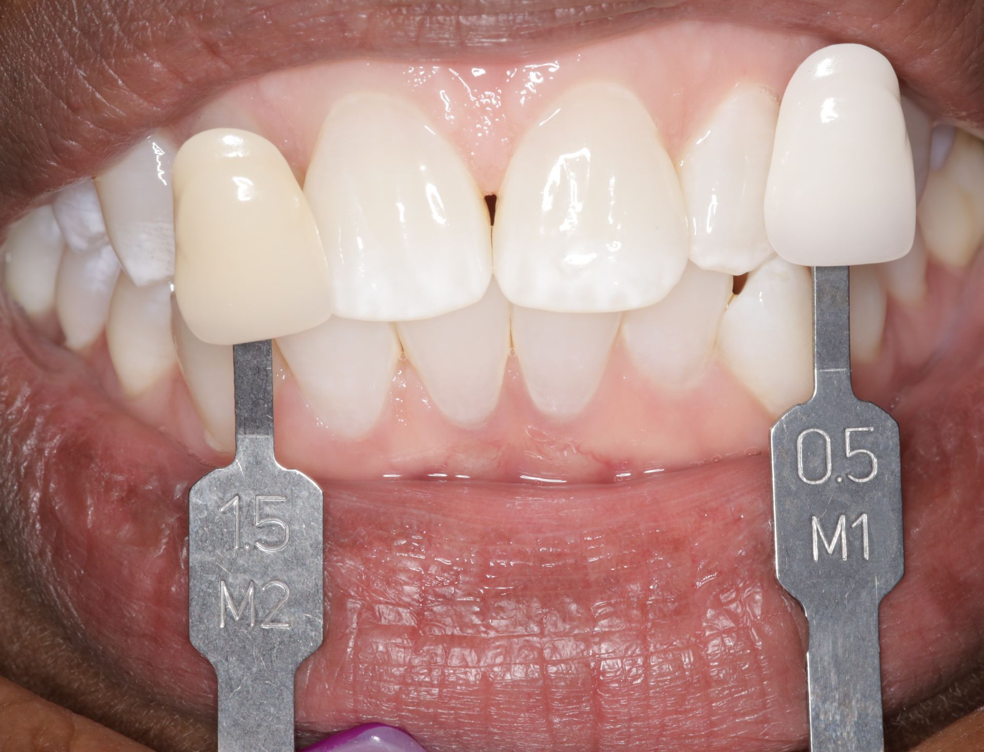 A close up of a person 's teeth with two tooth shades in front of them.