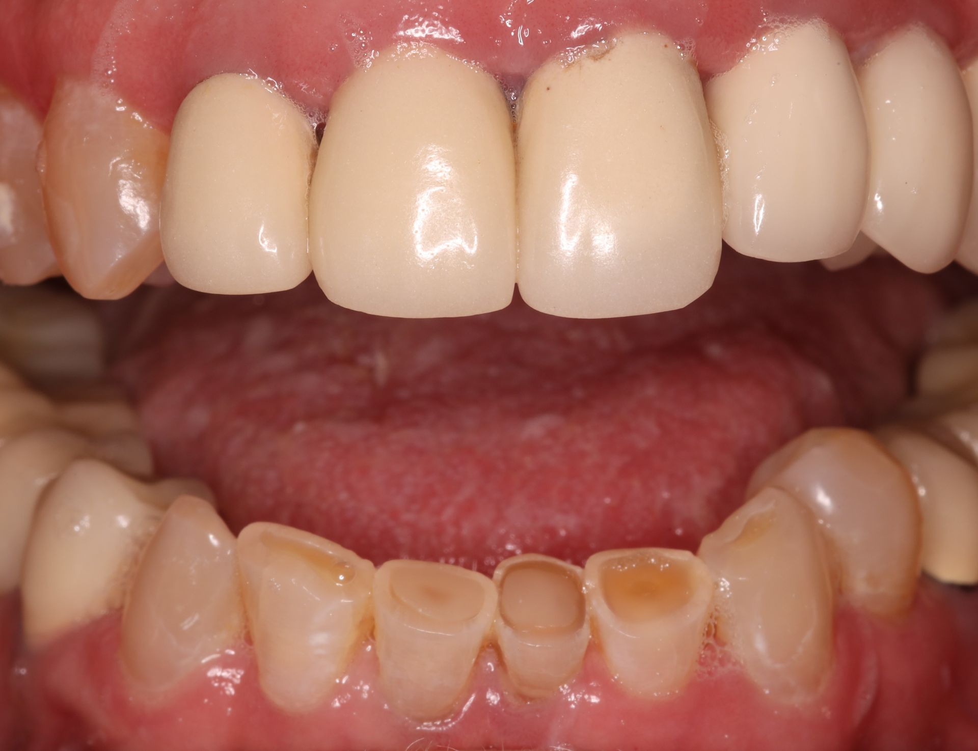 A close up of a person 's teeth with white teeth and brown teeth.