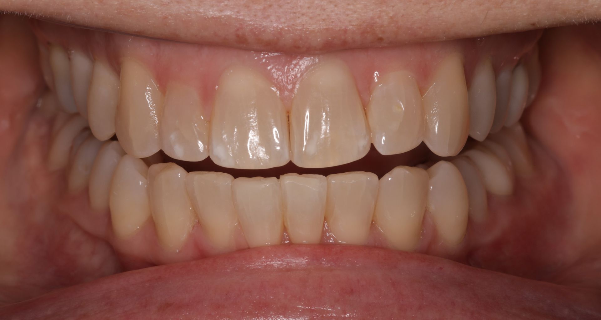 A close up of a person 's teeth with white teeth.