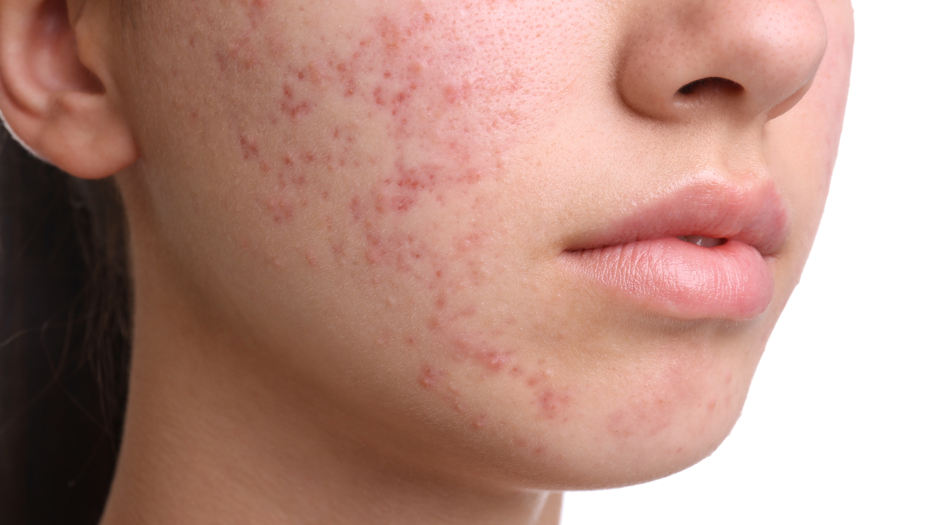 Close-up of a cheek with red acne blemishes on light skin
