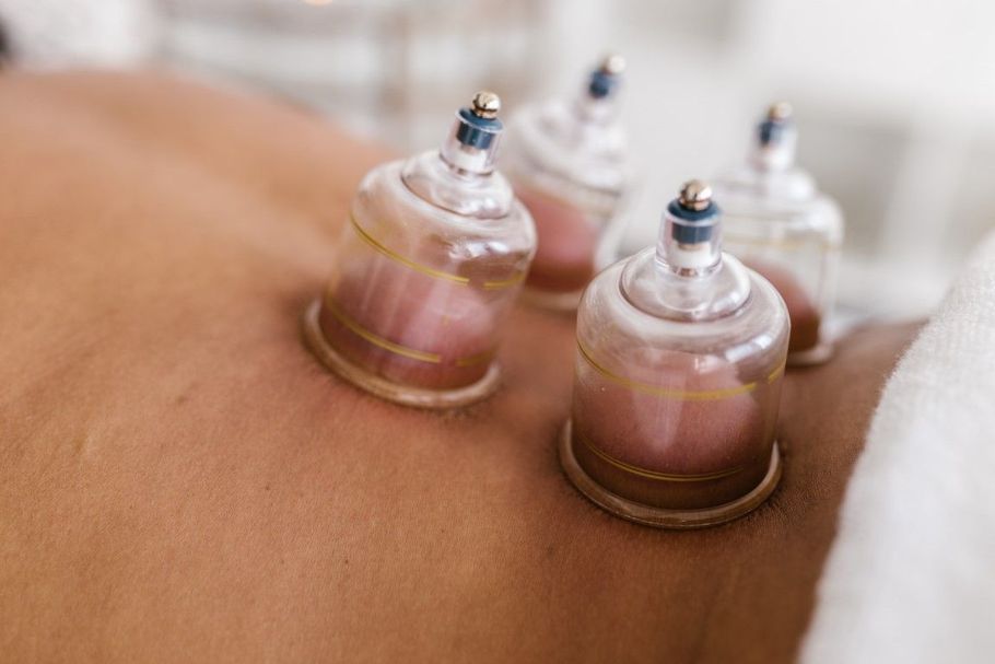 Cupping therapy cups attached to a person’s bare back, creating suction marks