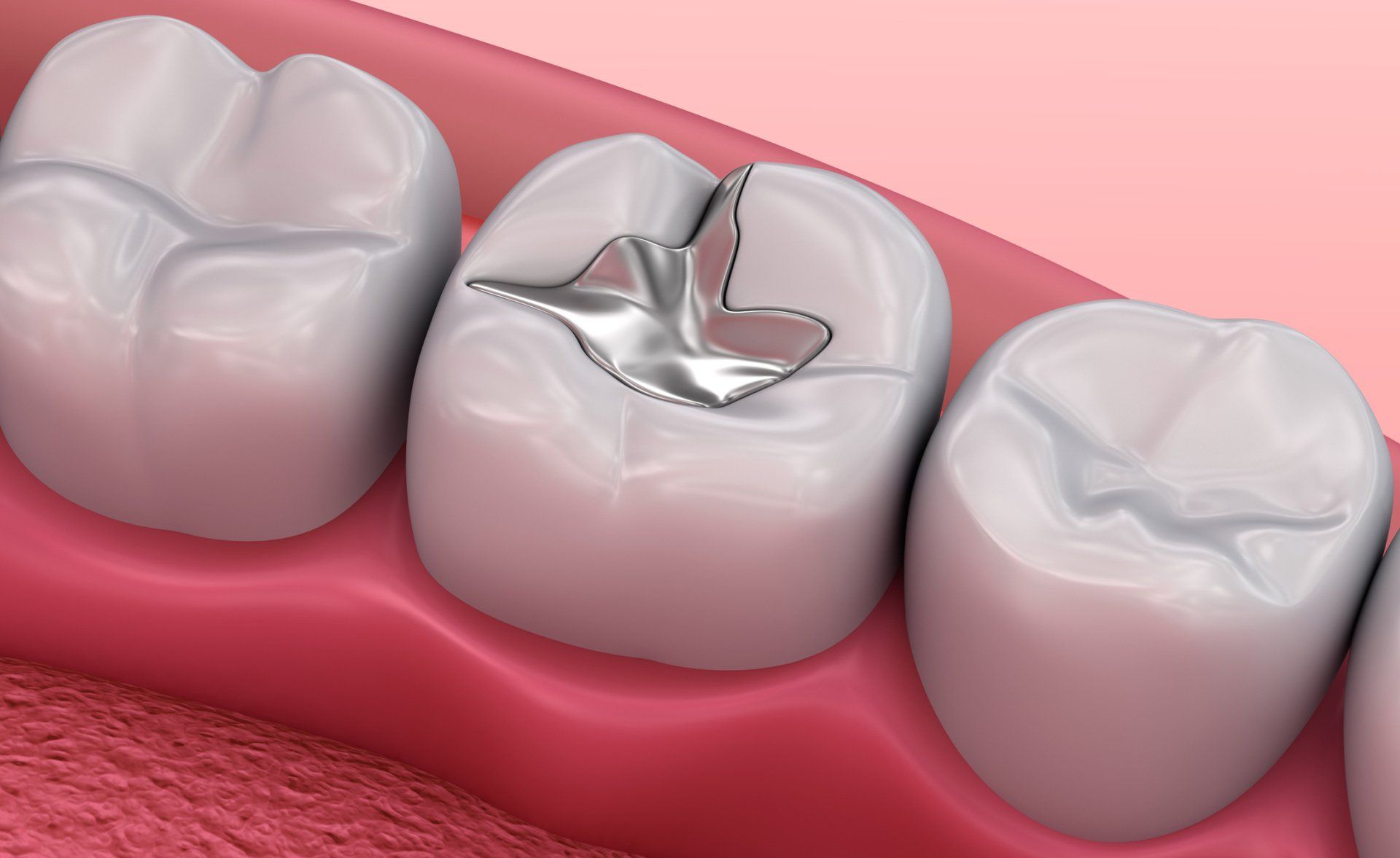 Dental Fillings