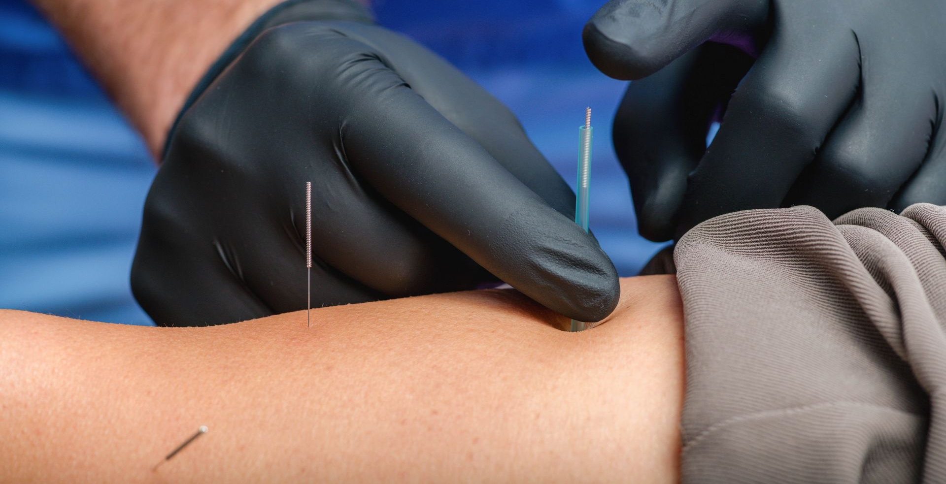 Dry Needling Adelaide for Chiropractic Care and Remedial Massage Services