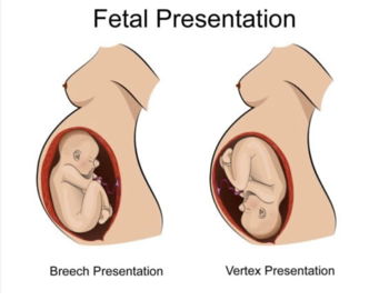 Fetal Presentation Showing Baby Breech Diagram