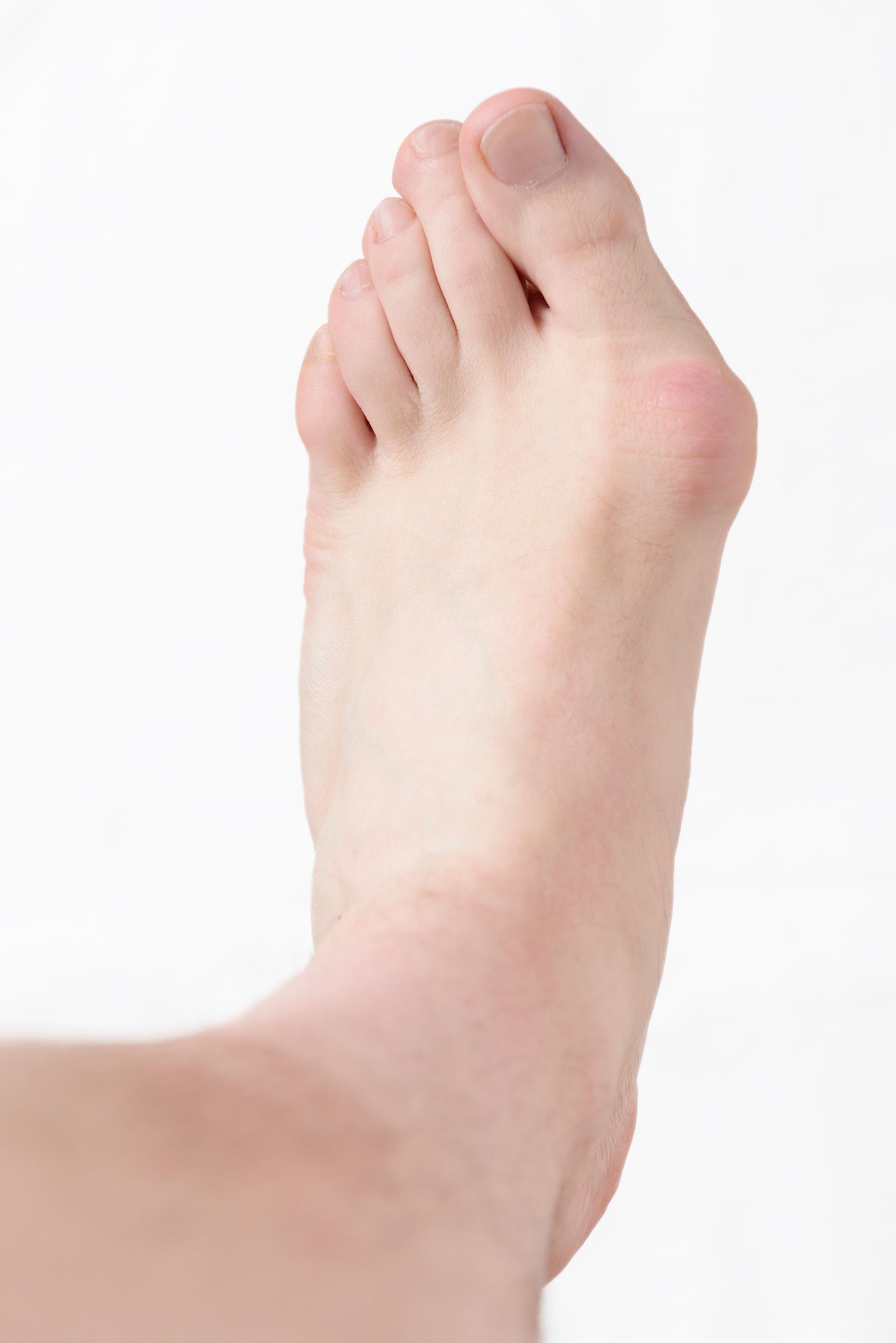 How Remedial Massage Helps with Bunion Discomfort