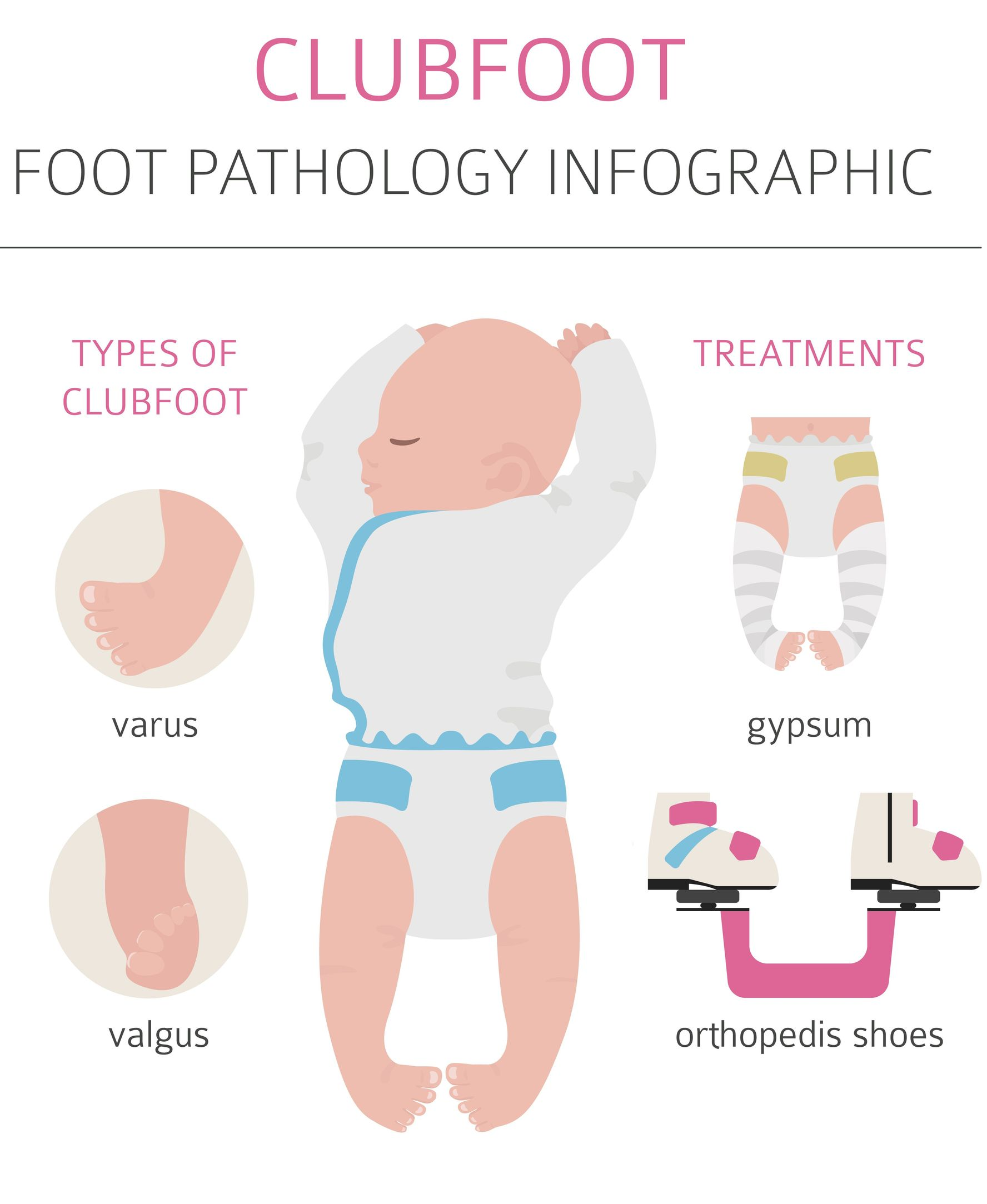Clubfoot Treatment Chiropractic Remedial Massage in Adelaide