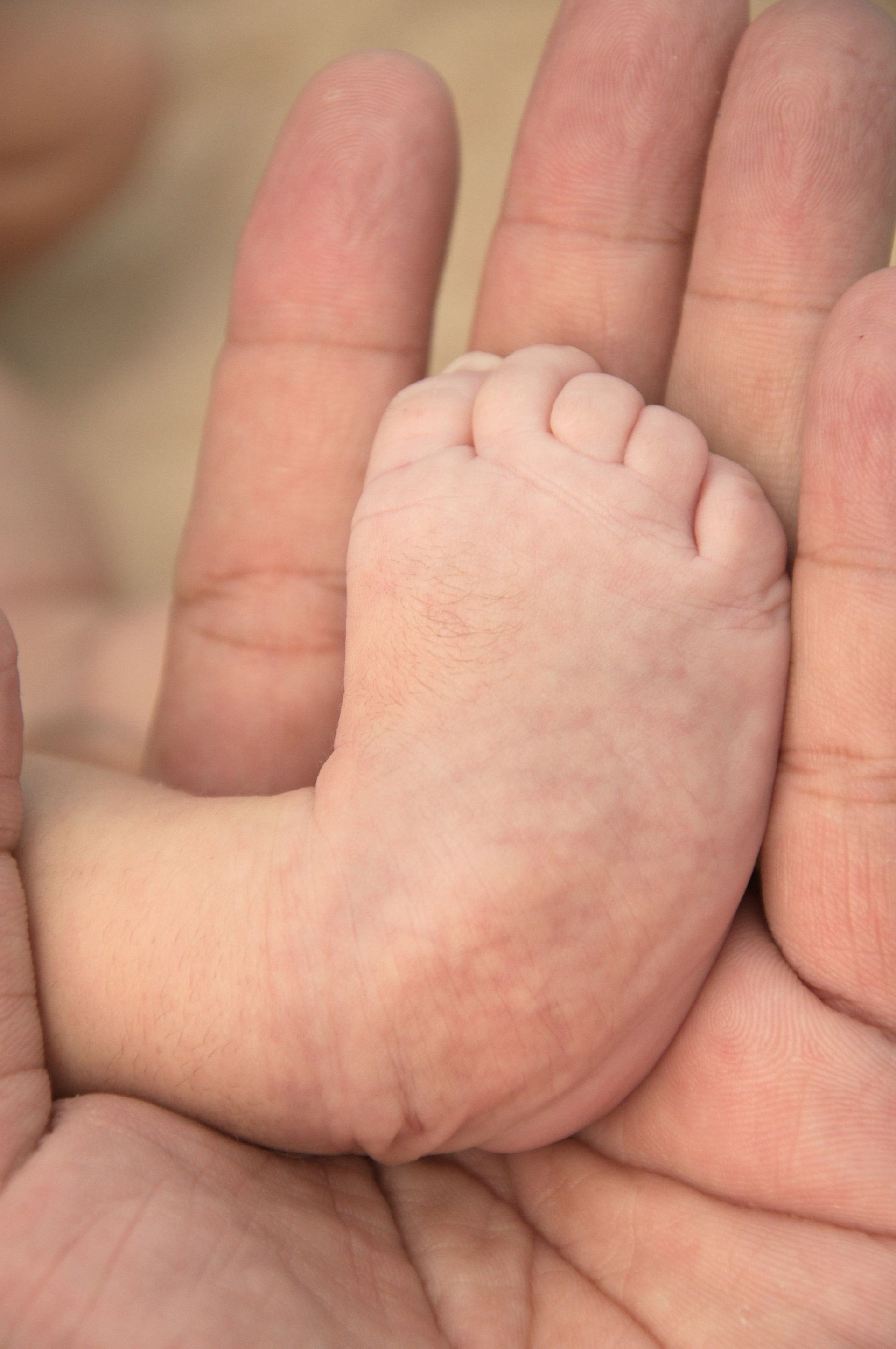 Understanding Clubfoot And Treatment In Adelaide