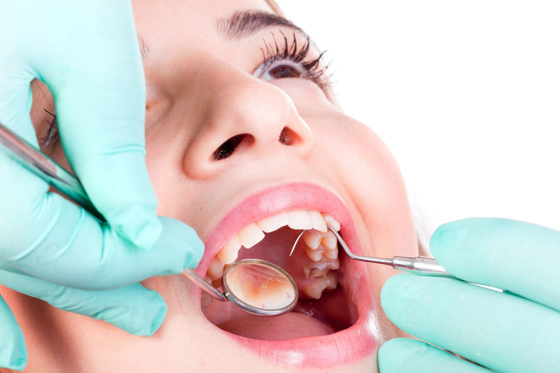 Wisdom Teeth Removal - Land, TX - Dr. Peter Pham, DDS