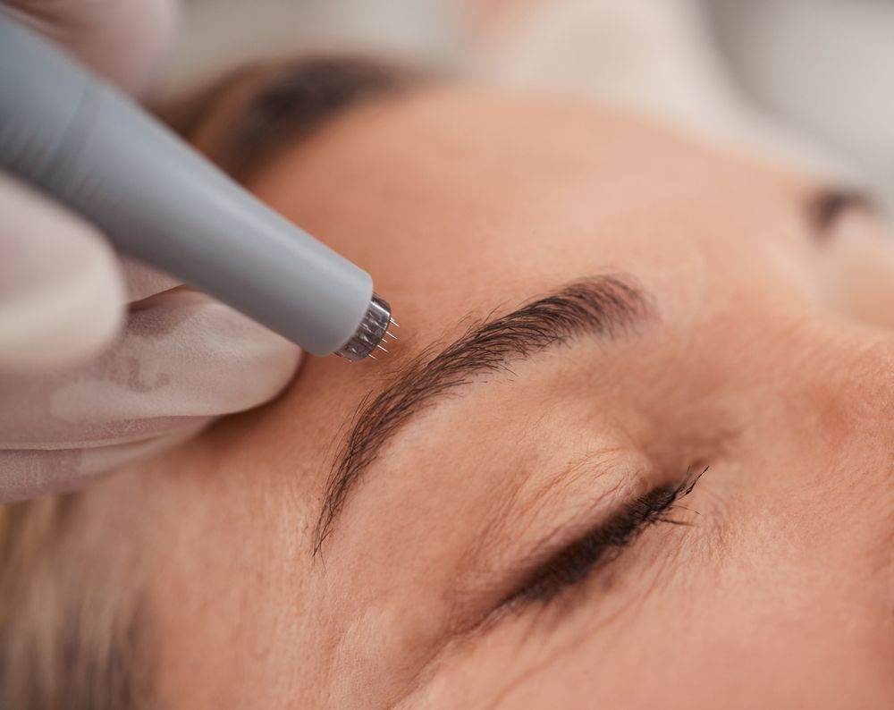 A Woman is Getting a Treatment on Her Forehead — Erikka's All Occasion Beauty In Rockhampton City, QLD