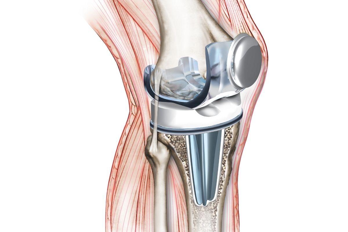 cirurgia-joelho-dr-diego-munhoz-ortopedista-sao-paulo