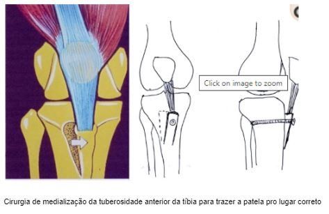 cirurgia-tibia-joelho-dr-diego-munhoz-ortopedista-especialista-cirurgia-joelho-sao-paulo